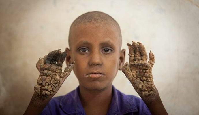 Menino de Bangladesh se transforma em árvore