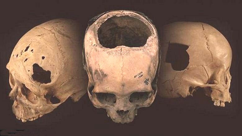 Os incas antigos fizeram craniotomia profissional