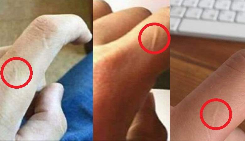 Muitas pessoas encontraram uma cicatriz misteriosa no dedo indicador
