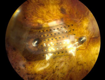 argus-II-retinal-implant-640x538