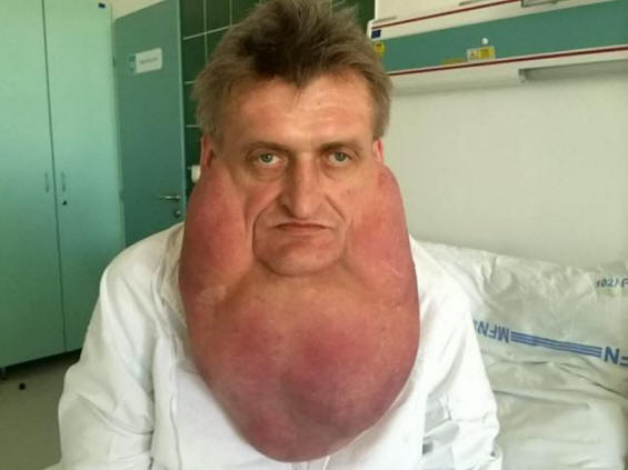 Os médicos removeram um tumor gigante do rosto de um homem